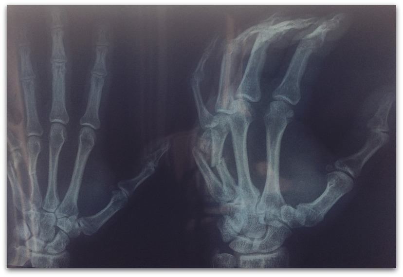 brokenhand